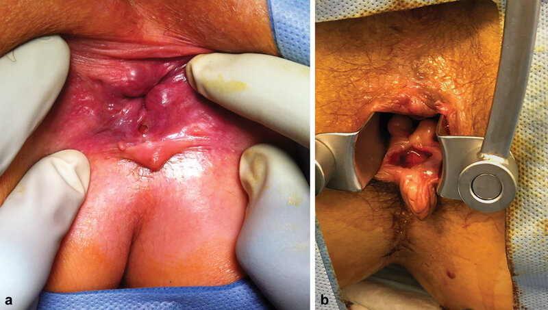 Anal Fissures Causes, Symptoms, and Where to Get Treatment in Philippines | PULSE CLINIC Manila & Angeles Clark | A Lifestyle Clinic. Anal Fissures Causes, Symptoms, and Where to Get Treatment in Philippines | PULSE CLINIC Manila & Angeles Clark | A Lifestyle Clinic.